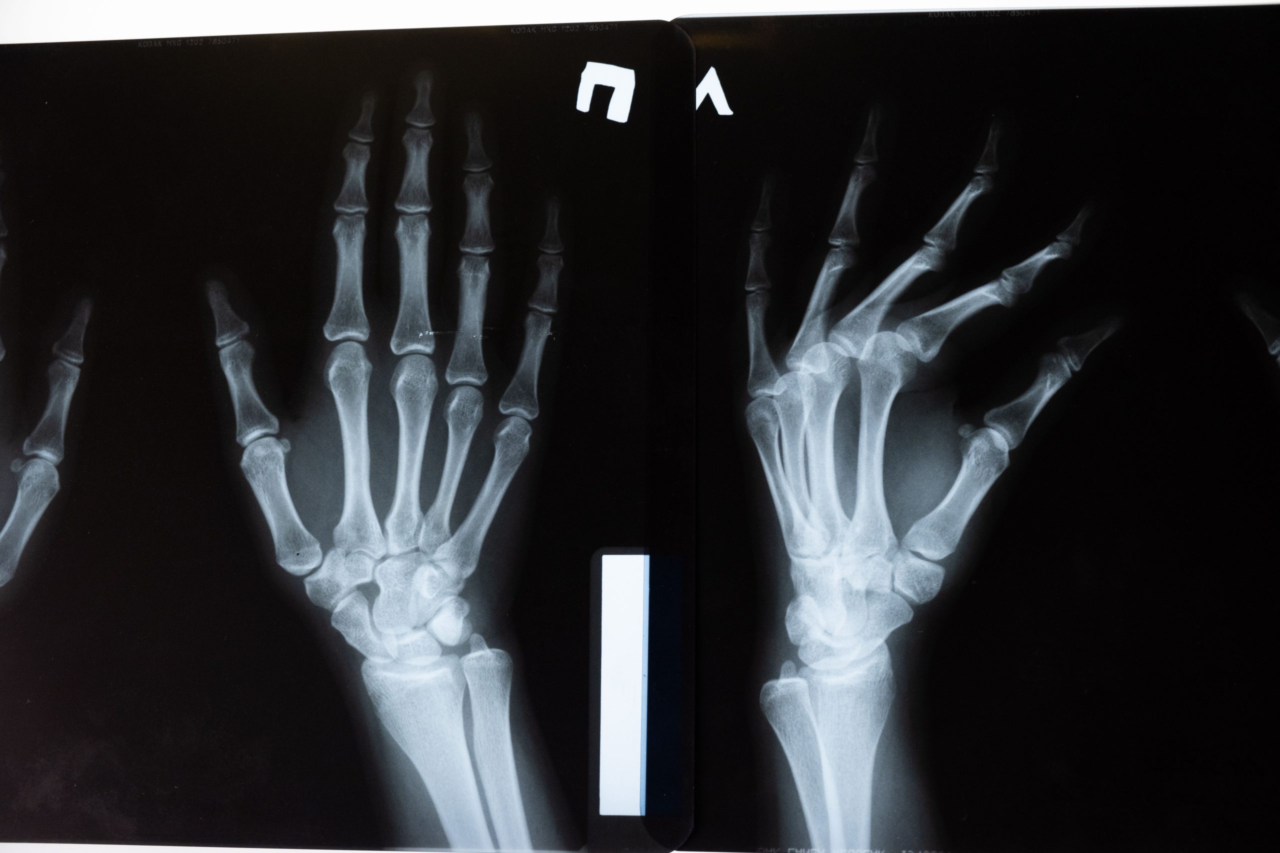Image radiographique de l'anatomie de la main