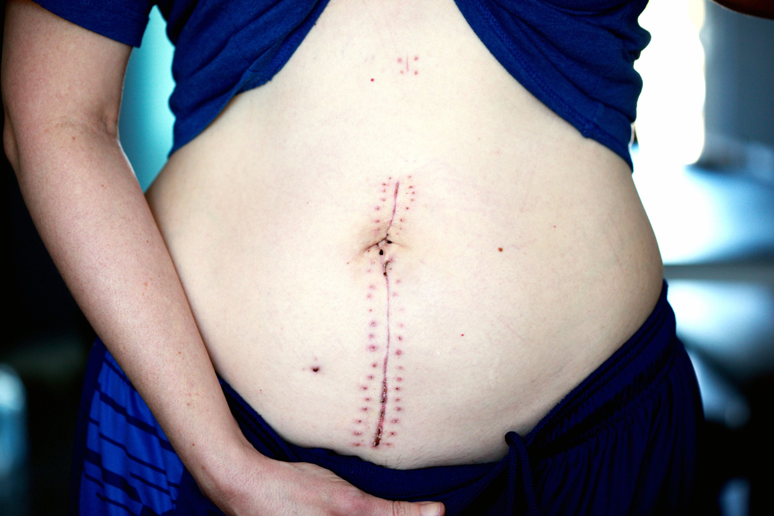 Cicatrice abdominale en cours de guérison