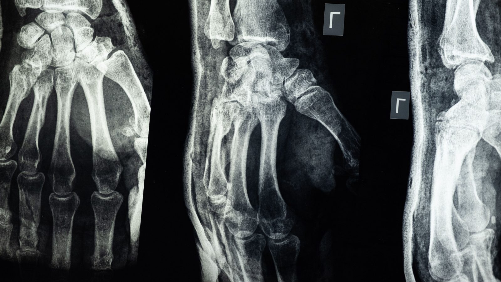Radiographie détaillée des os de la main