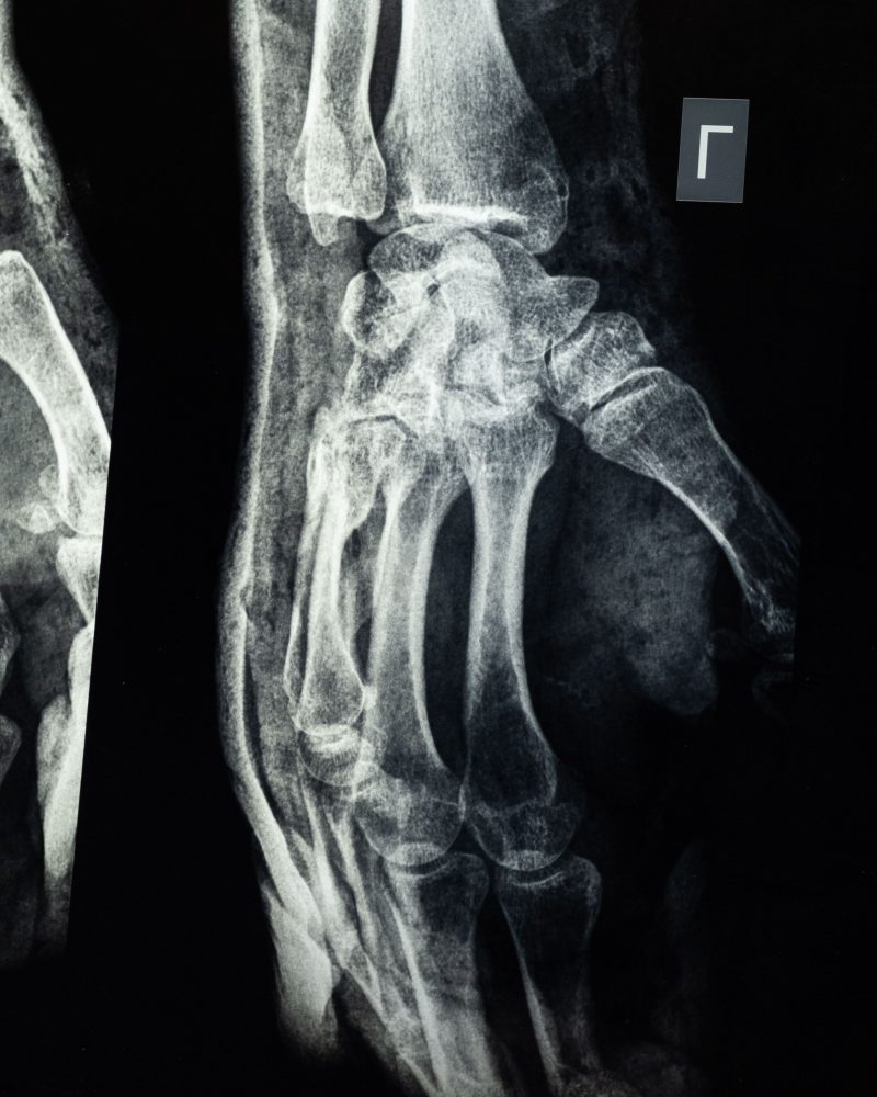 Radiographie détaillée des os de la main