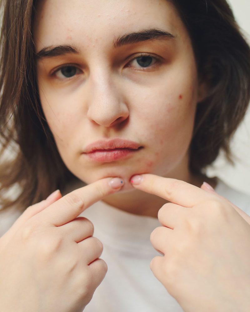 Femme touchant son visage marqué par des lésions